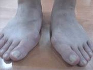 Malattie comuni dei piedi del bambino- hallux valgus